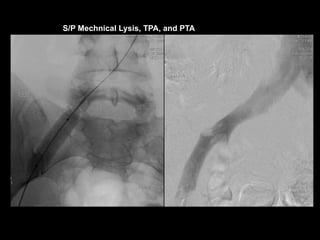 S/P Mechnical Lysis, TPA, and PTA
 