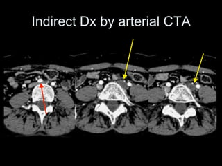Indirect Dx by arterial CTA
 