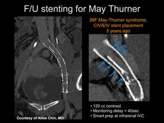 • 120 cc contrast
• Monitoring delay = 40sec
• Smart prep at infrarenal IVC
28F May-Thurner syndrome,
CIV/EIV stent placement
3 years ago
Courtesy of Anne Chin, MD
F/U stenting for May Thurner
 