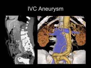 IVC Aneurysm
 