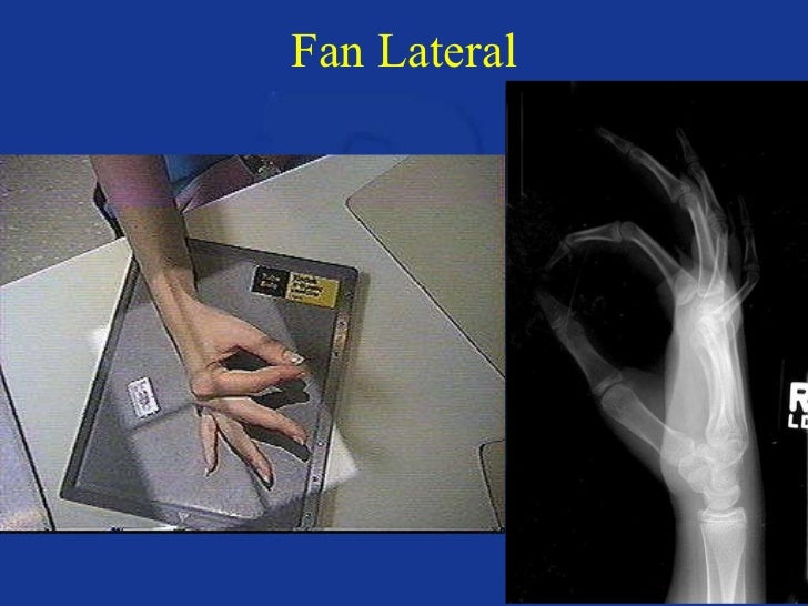 [PDF] Handy views radiographic positioning of the hand and wrist