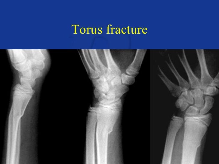 treatment torus fracture humerus treatment torus fracture humerus
