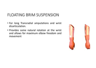 FLOATING BRIM SUSPENSION
• For long Transradial amputations and wrist
disarticulation.
• Provides some natural rotation at the wrist
and allows for maximum elbow freedom and
movement
 