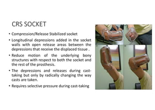 CRS SOCKET
• Compression/Release Stabilized socket
• Longitudinal depressions added in the socket
walls with open release areas between the
depressions that receive the displaced tissue .
• Reduce motion of the underlying bony
structures with respect to both the socket and
the rest of the prosthesis.
• The depressions and releases during cast-
taking but only by radically changing the way
casts are taken.
• Requires selective pressure during cast-taking
 