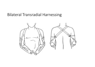Bilateral Transradial Harnessing
 