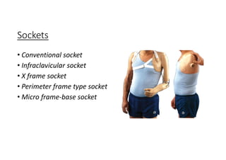 Sockets
• Conventional socket
• Infraclavicular socket
• X frame socket
• Perimeter frame type socket
• Micro frame-base socket
 