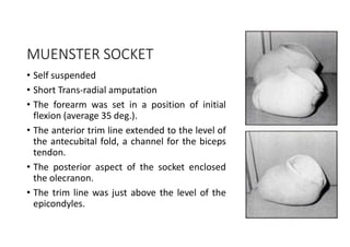 MUENSTER SOCKET
• Self suspended
• Short Trans-radial amputation
• The forearm was set in a position of initial
flexion (average 35 deg.).
• The anterior trim line extended to the level of
the antecubital fold, a channel for the biceps
tendon.
• The posterior aspect of the socket enclosed
the olecranon.
• The trim line was just above the level of the
epicondyles.
 