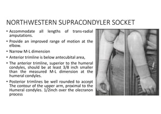 NORTHWESTERN SUPRACONDYLER SOCKET
• Accommodate all lengths of trans-radial
amputations.
• Provide an improved range of motion at the
elbow.
• Narrow M-L dimension
• Anterior trimline is below antecubital area,
• The anterior trimline, superior to the humeral
condyles, should be at least 3/8 inch smaller
than the measured M-L dimension at the
humeral condyles.
• Posterior trimlines be well rounded to accept
The contour of the upper arm, proximal to the
Humeral condyles. 1/2inch over the olecranon
process
 