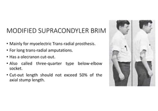 MODIFIED SUPRACONDYLER BRIM
• Mainly for myoelectric Trans-radial prosthesis.
• For long trans-radial amputations.
• Has a olecranon cut-out.
• Also called three-quarter type below-elbow
socket.
• Cut-out length should not exceed 50% of the
axial stump length.
 