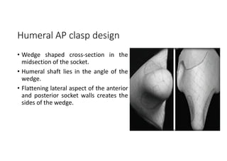 Humeral AP clasp design
• Wedge shaped cross-section in the
midsection of the socket.
• Humeral shaft lies in the angle of the
wedge.
• Flattening lateral aspect of the anterior
and posterior socket walls creates the
sides of the wedge.
 