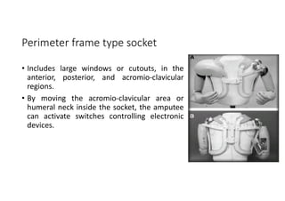 Perimeter frame type socket
• Includes large windows or cutouts, in the
anterior, posterior, and acromio-clavicular
regions.
• By moving the acromio-clavicular area or
humeral neck inside the socket, the amputee
can activate switches controlling electronic
devices.
 