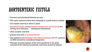 AORTOENTERIC FISTULA
 Primary aortoduodenal fistulas are rare
 The more common entity seen clinically is a graft-enteric erosion
 the median interval is about 3 years
 pseudoaneurysm at the proximal anastomotic suture line in the
setting of an infection  subsequent fistulization
 often massive and fatal
 present first with a “sentinel bleed.”
 Any evidence of bleeding in the distal duodenum (3rd
/4th
portion)
on EGD should be considered diagnostic
 Therapy includes ligation of the aorta proximal to the graft,
removal of the infected prosthesis, and extra-anatomic bypass
 