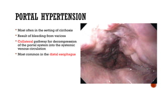 PORTAL HYPERTENSION
 Most often in the setting of cirrhosis
 Result of bleeding from varices
 Collateral pathway for decompression
of the portal system into the systemic
venous circulation
 Most common in the distal esophagus
 
