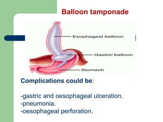 Complications could be:
-gastric and oesophageal ulceration.
-pneumonia.
-oesophageal perforation.
Balloon tamponade
 