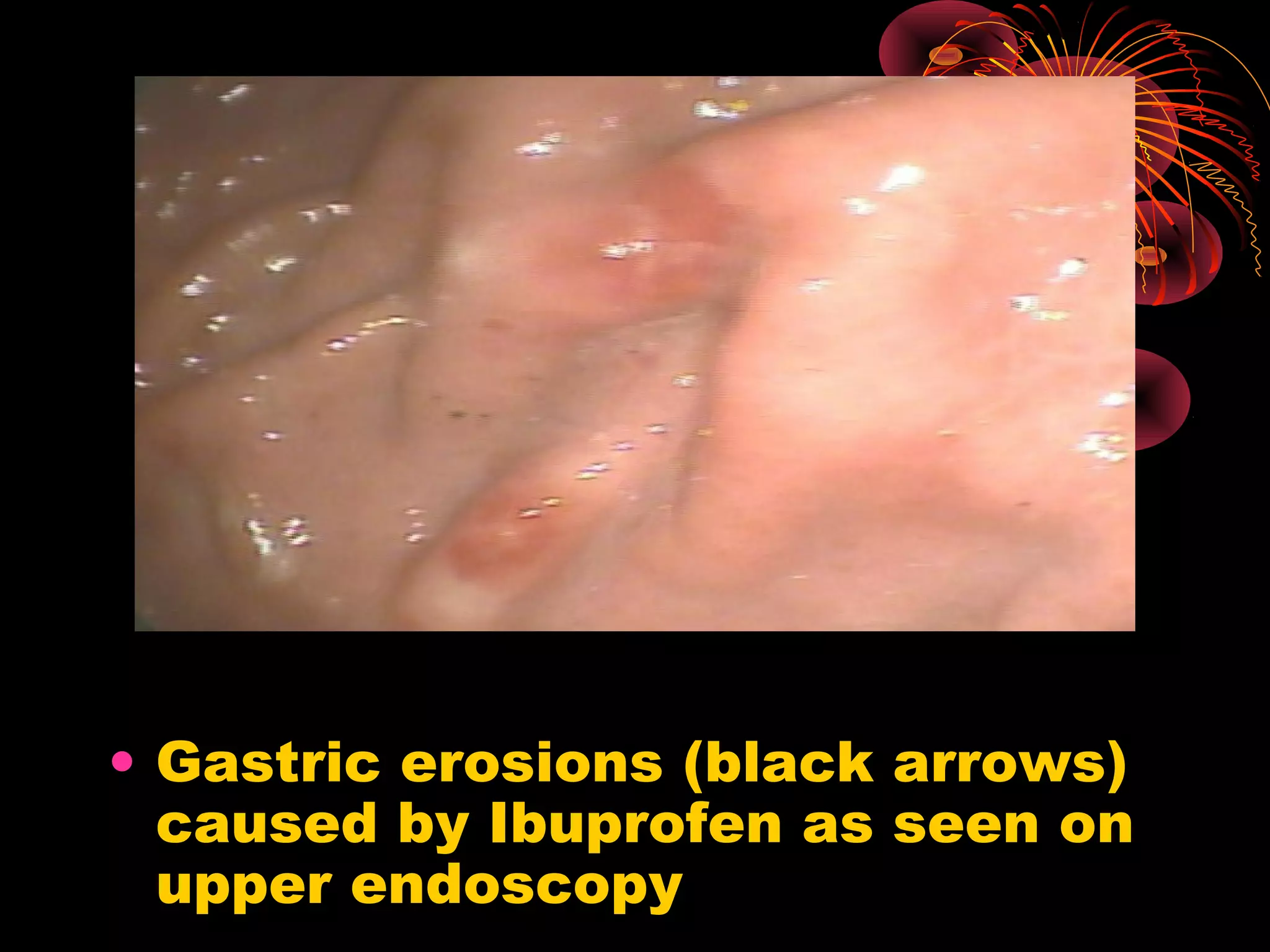 • Gastric erosions (black arrows)
  caused by Ibuprofen as seen on
  upper endoscopy
 