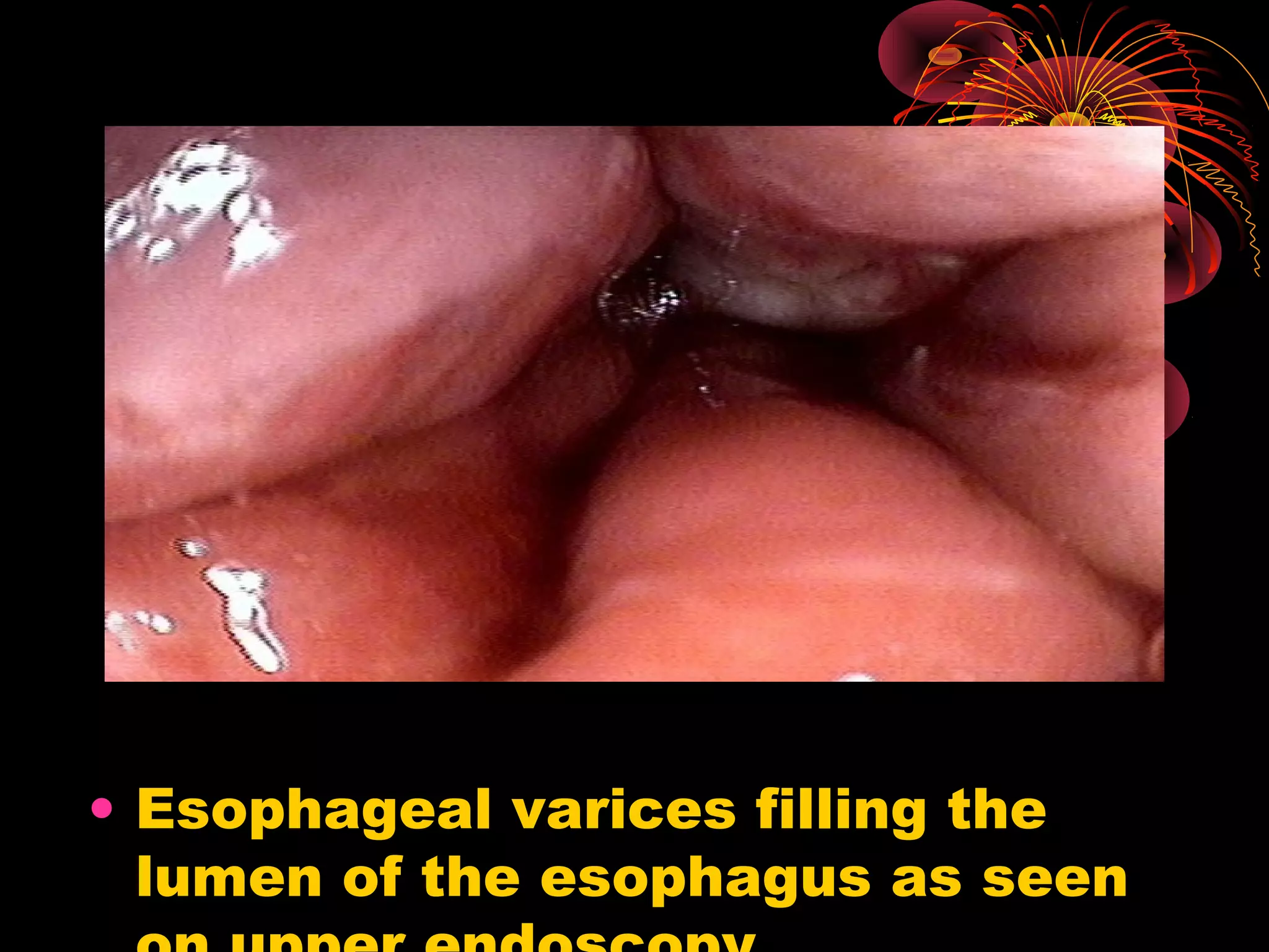 • Esophageal varices filling the
  lumen of the esophagus as seen
 