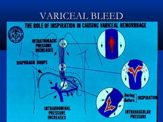 VARICEAL BLEEDVARICEAL BLEED
 