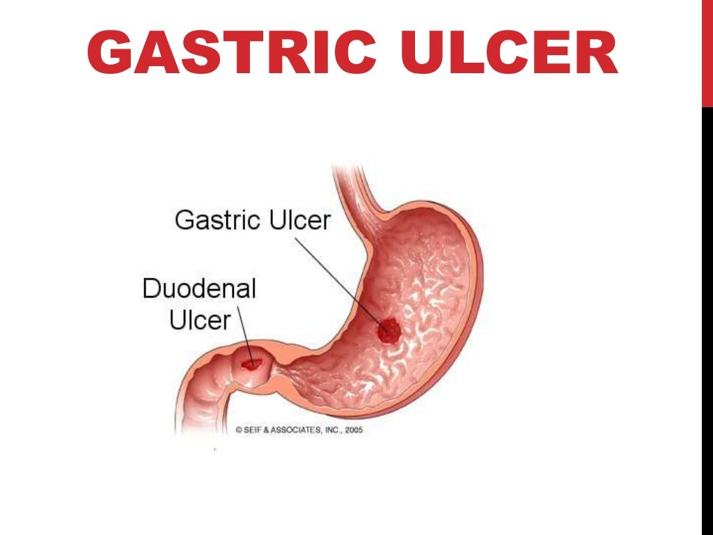 Гастрит с повышенной кислотностью диета таблица. Эрозивный гастрит желудка. Диета стол 1 список продуктов. Диета 5 стол памятка. Стол 5 диета меню.