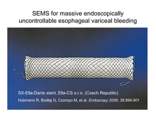 SEMS for massive endoscopically
uncontrollable esophageal variceal bleeding
SX-Ella-Danis stent, Ella-CS s.r.o. (Czech Republic)
Hubmann R, Bodlaj G, Czompo M, et al. Endoscopy 2006; 38:896-901
 