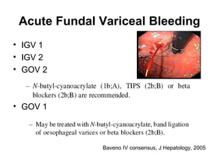 Acute Fundal Variceal Bleeding
• IGV 1
• IGV 2
• GOV 2
• GOV 1
Baveno IV consensus, J Hepatology, 2005
 