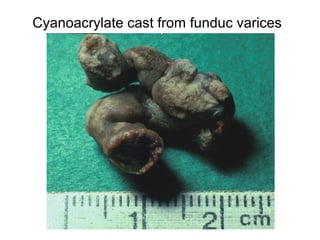 Cyanoacrylate cast from funduc varices
 