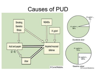 Causes of PUD
 