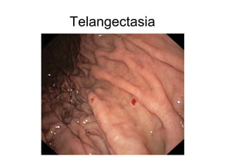 Telangectasia
 