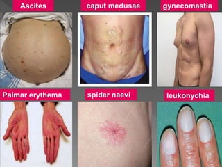 Ascites caput medusae gynecomastia
Palmar erythema spider naevi leukonychia
 