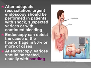  After adequate
resuscitation, urgent
endoscopy should be
performed in patients
with shock, suspected
varices or with
continued bleeding
 Endoscopy can detect
the cause of the
hemorrhage in 80% or
more of cases
 At endoscopy, Varices
should be treated,
usually with banding
 