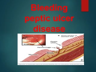 Bleeding
peptic ulcer
disease
 