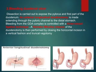 2.Bleeding duodenal ulcer
Dissection is carried out to expose the pylorus and first part of the
duodenum. An anterior longitudinal duodenotomy is made
extending through the pyloric channel to the distal stomach.
Bleeding from the GDA complex is controlled with a three-vessel
ligation technique.. A Heineke Mikulicz closure of the
duodenotomy is then performed by closing the horizontal incision in
a vertical fashion and truncal vagotomy
 
