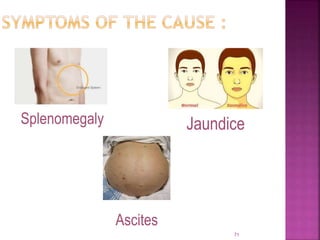 71
Ascites
Splenomegaly Jaundice
 