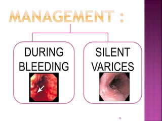 74
DURING
BLEEDING
SILENT
VARICES
 