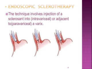 The technique involves injection of a
sclerosant into (intravariceal) or adjacent
to(paravariceal) a varix.
78
 
