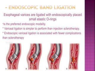 Esophageal varices are ligated with endoscopically placed
small elastic O-rings
*is the preferred endoscopic modality.
* Variceal ligation is simpler to perform than injection sclerotherapy.
* Endoscopic variceal ligation is associated with fewer complications
than sclerotherapy
79
 