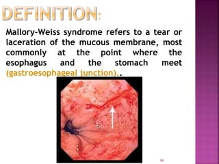 Mallory-Weiss syndrome refers to a tear or
laceration of the mucous membrane, most
commonly at the point where the
esophagus and the stomach meet
(gastroesophageal junction)..
86
 