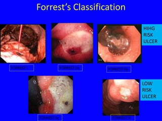 Upper GI bleeding gastroenterology .pptx