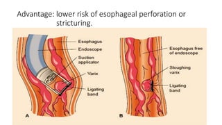 Advantage: lower risk of esophageal perforation or
stricturing.
 