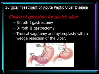 Choice of operation for gastric ulcer
– Billroth I gastrectomy
– Billroth II gastrectomy
– Truncal vagotomy and pyloroplasty with a
wedge resection of the ulcer,
 
