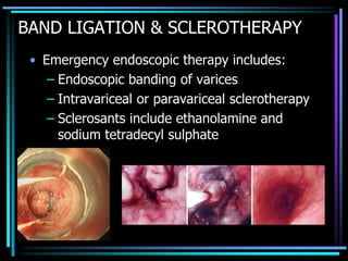 BAND LIGATION & SCLEROTHERAPY
• Emergency endoscopic therapy includes:
– Endoscopic banding of varices
– Intravariceal or paravariceal sclerotherapy
– Sclerosants include ethanolamine and
sodium tetradecyl sulphate
 