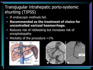Transjugular intrahepatic porto-systemic
shunting (TIPSS)
• If endoscopic methods fail.
• Recommended as the treatment of choice for
uncontrolled variceal haemorrhage.
• Reduces risk of rebleeding but increases risk of
encephalopathy
• Mortality of the procedure ~1%
 