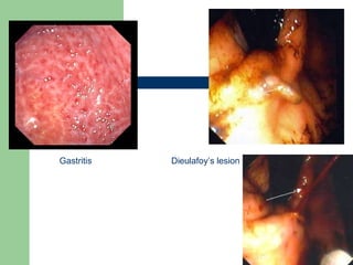 Gastritis Dieulafoy’s lesion 