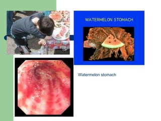 Watermelon stomach 