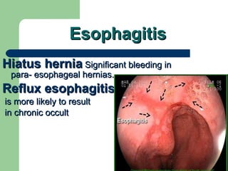 Esophagitis Hiatus hernia  Significant bleeding in para- esophageal hernias. Reflux esophagitis is more likely to result in chronic occult 