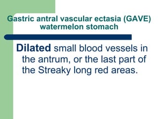Gastric antral vascular ectasia (GAVE)  watermelon stomach   Dilated  small blood vessels in the  antrum , or the last part of the Streaky long red areas. 