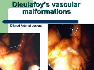 Dieulafoy’s vascular  malformations   Dilated Arterial Lesions 