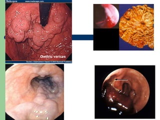 Gastric varices 