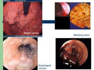 Gastric varices Bleeding ulcers Esophageal Varices 