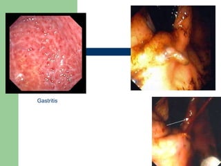 Gastritis 