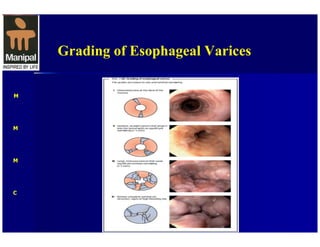 Jsph Varices Classification Upper GI Hemorrhage-- Surgical perspective | PDF